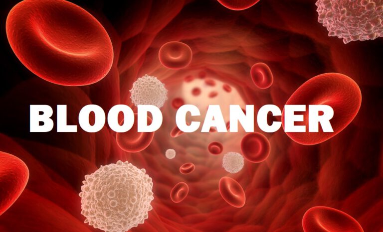 कस्ता व्यक्तिलाई हुन्छ ब्लड क्यान्सर ?यसरी बच्न सकिन्छ
