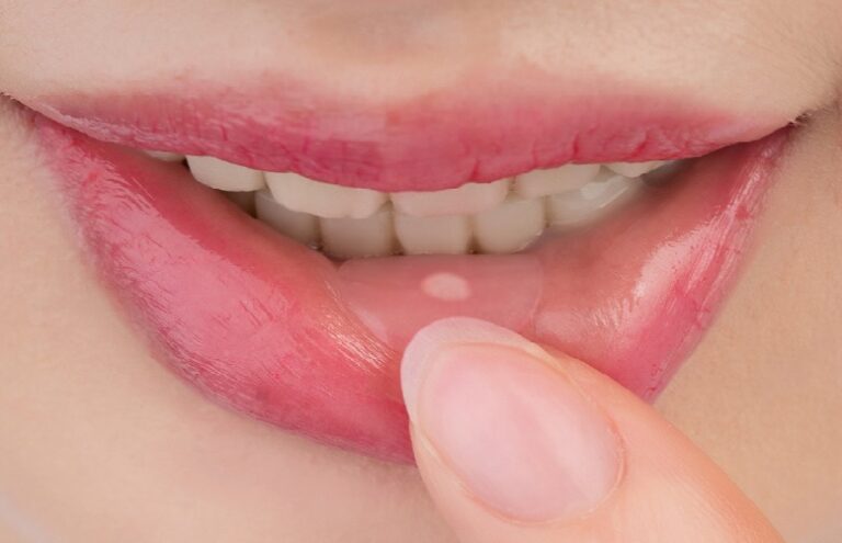 मुखको क्यान्सरबाट कसरी जोगिने ?