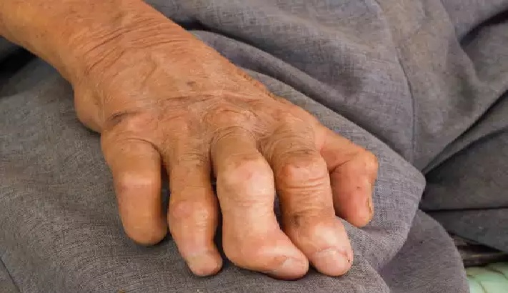 मधेस र लुम्बिनी प्रदेशमा कुष्ठरोग प्रभावित धेरै